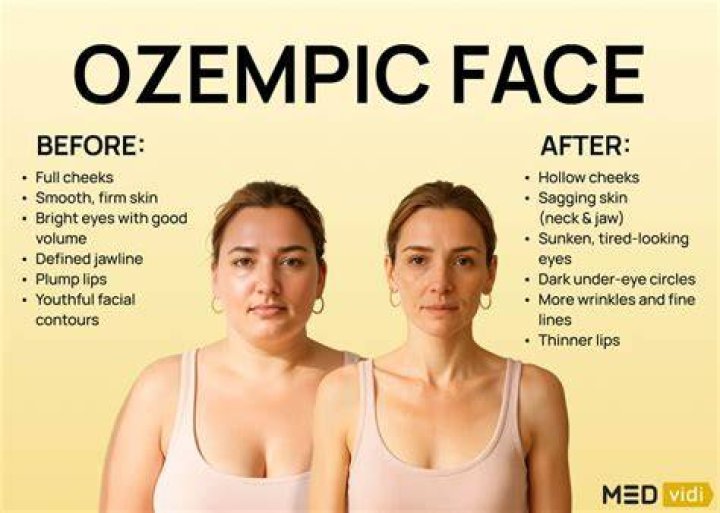 'Botched' doc issues Ozempic warning after Lisa Marie Presley autopsy
