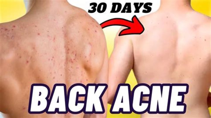 3 easy ways to get rid of back acne or 'bacne': dermatologist