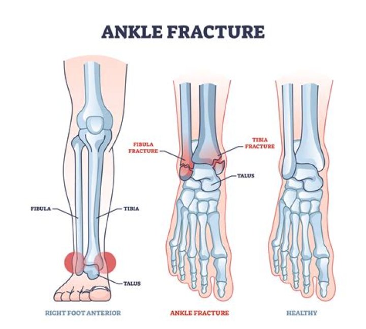 Anthony Rendon has fractured tibia, Angels didn't announce it