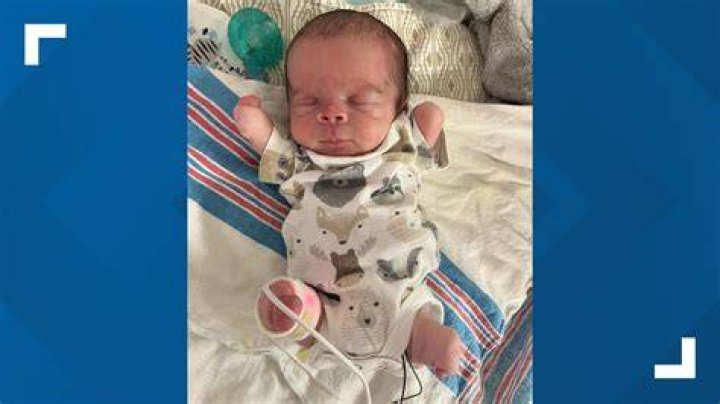Baby born with 4 arms, 4 legs hailed as 'miracle of nature'