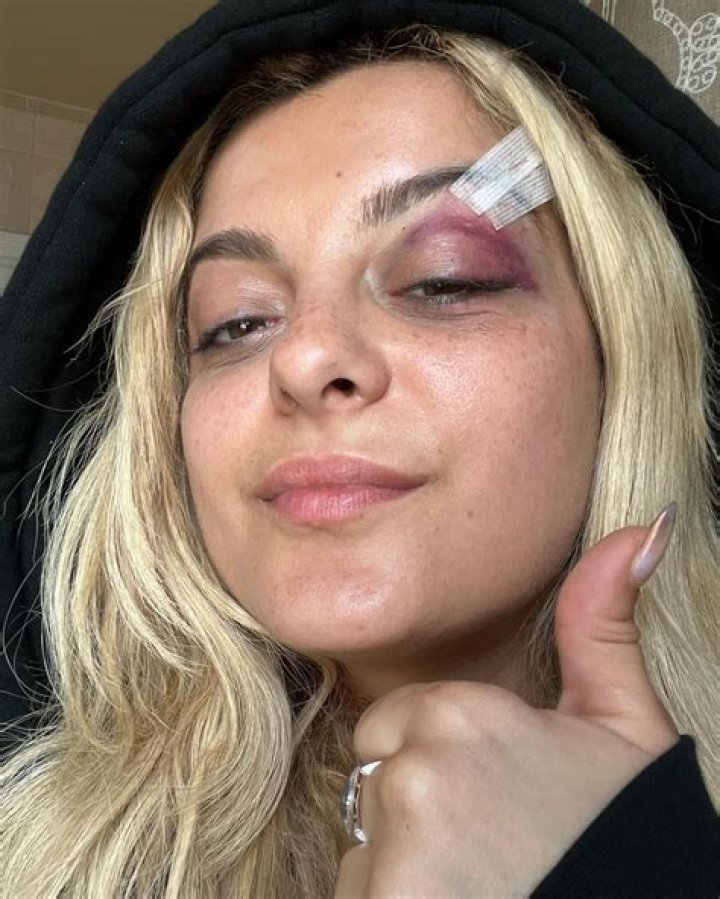 Bebe Rexha tells fans 'no phones at my face' in stage return after NYC assault left her with stitches