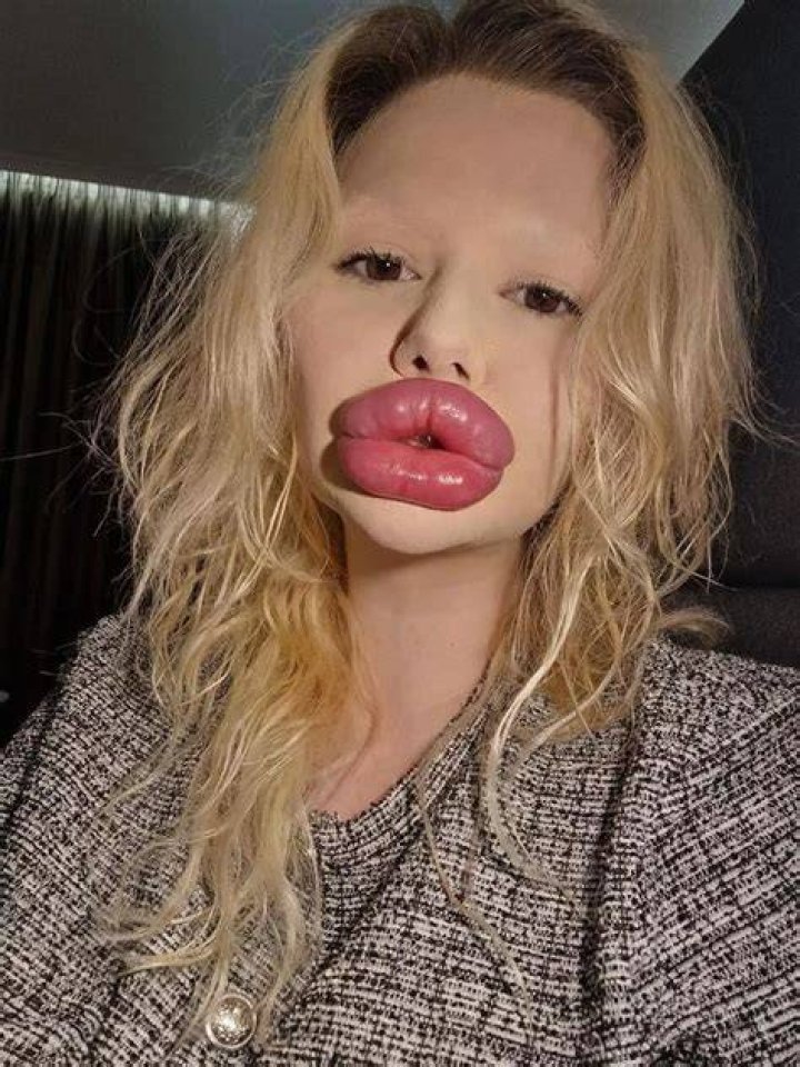 Biggest lips in the world? 22-year-old Barbie is on her way