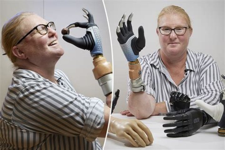 ‘Bionic woman’ is first to have robotic limb merged with bone — and controlled with her mind