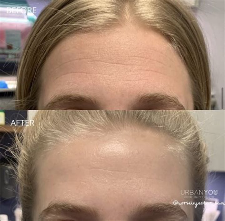 Botox losing face amid celeb backlash