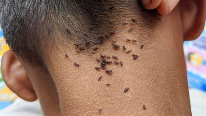 Can children's head lice be treated with mayonnaise or oil?
