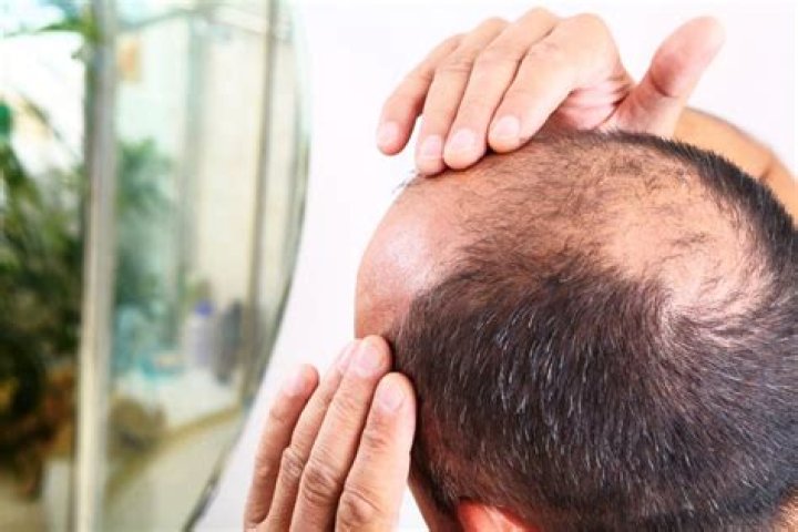 Cure for baldness might be hiding in your hairy moles: study