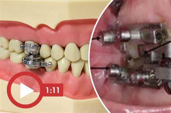 Device that locks jaw shut to tackle obesity sparks outrage