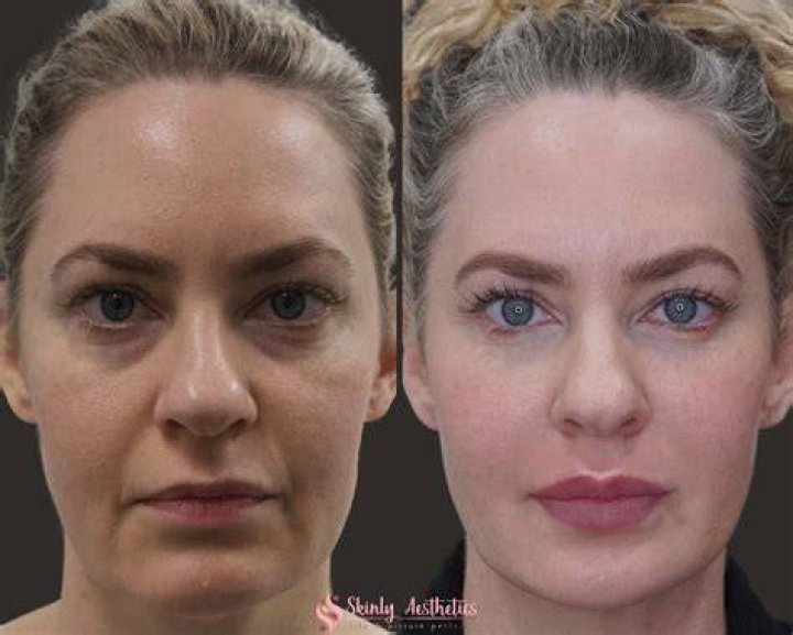 Face filler ‘burned and melted’ my nose off — and it could happen to anyone