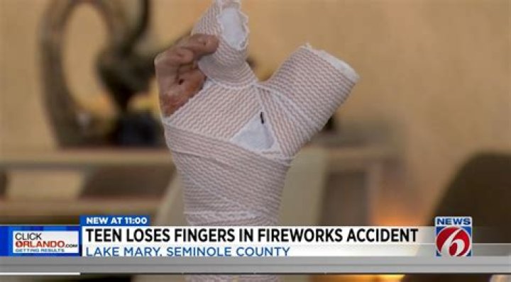 Florida teen has 3 fingers amputated in firework explosion