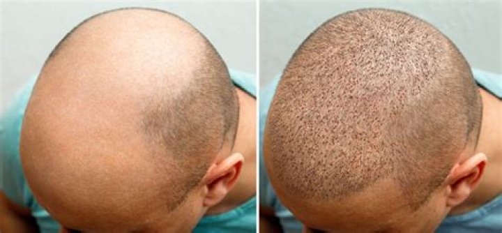 Hair transplant patient says he's 'ugly' and a catfish