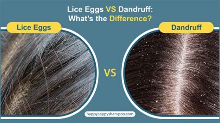 Hairdresser finds 150-egg lice infestation in client's hair