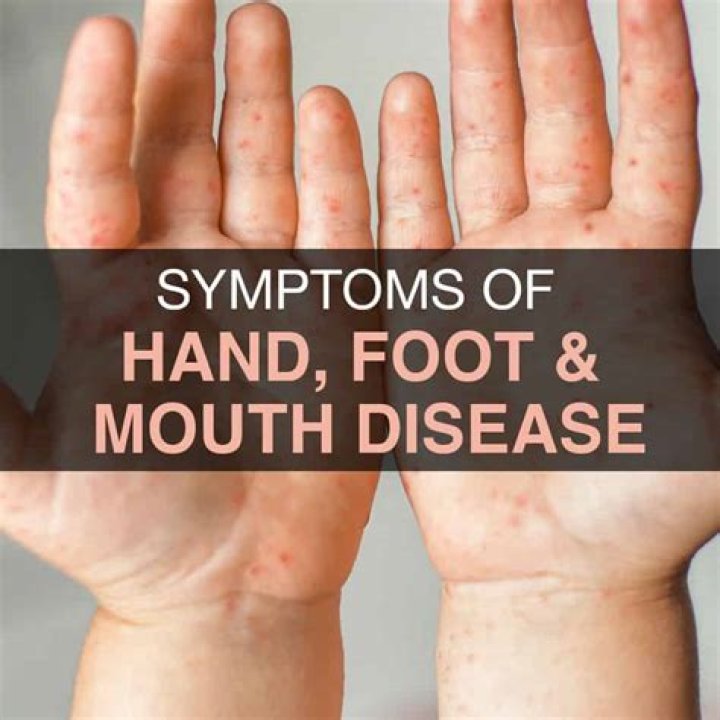 How adults can get hand, foot and mouth disease