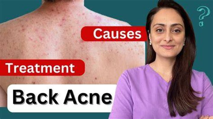 How to get rid of back acne, according to a dermatologist