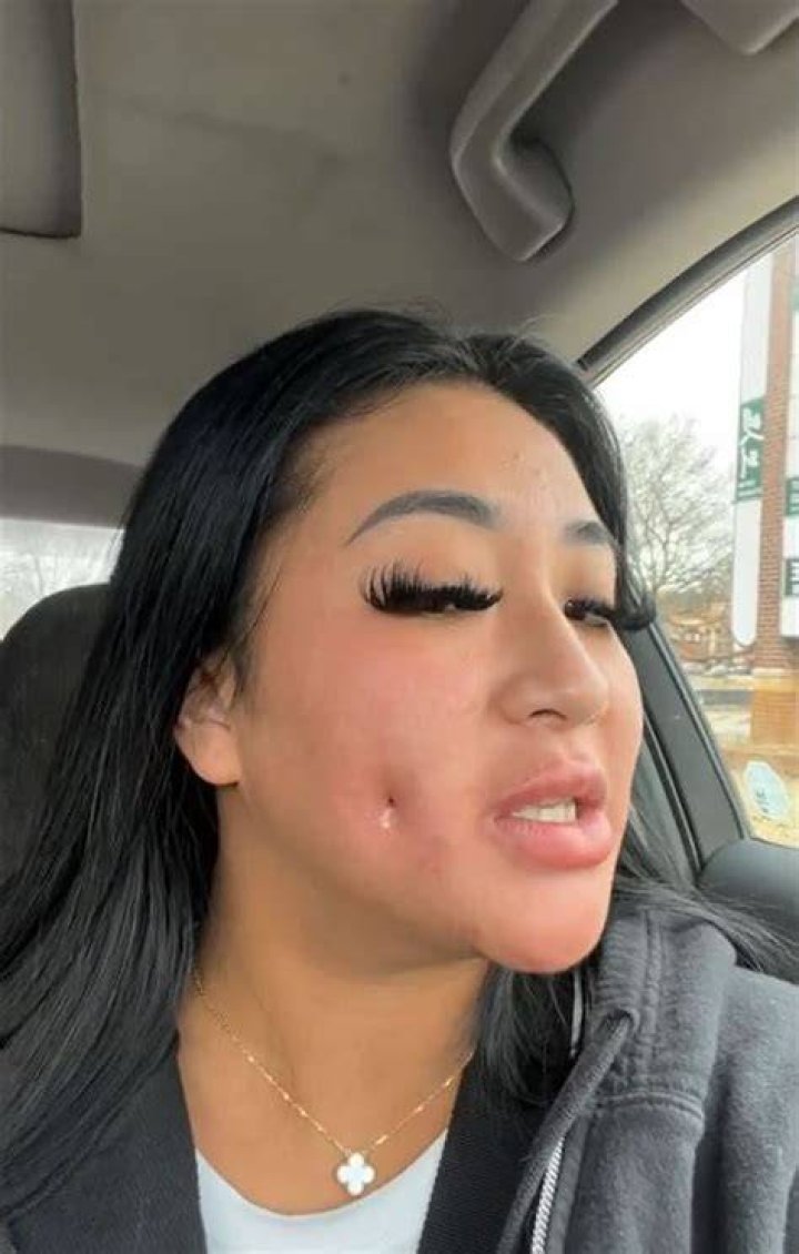 I dreamed of having dimples — so I paid $1.5K to get my cheeks stitched