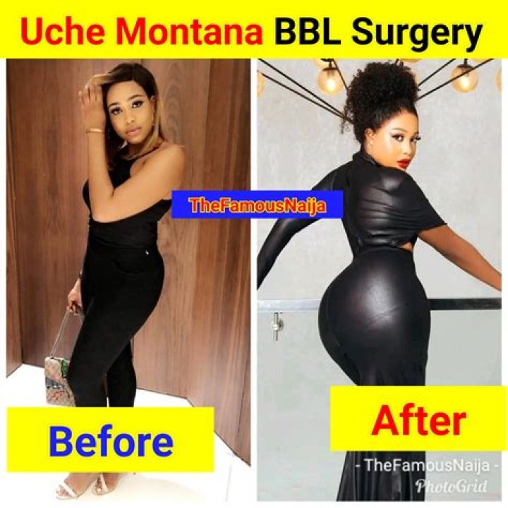 I got a BBL and lipo — it felt like I got burned all over my body