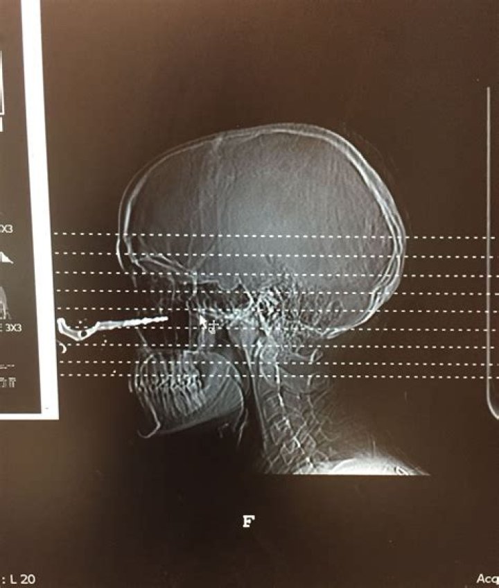 I got a car key lodged in my face — doctors were amazed by the freak accident