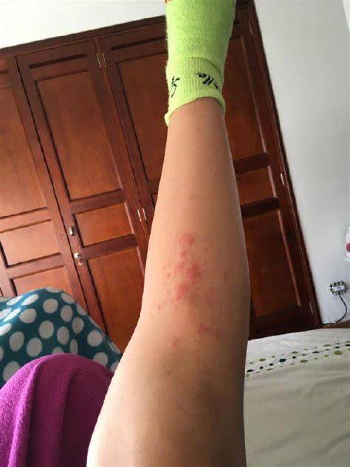 I got a rash on vacation — it was parasites living in my leg