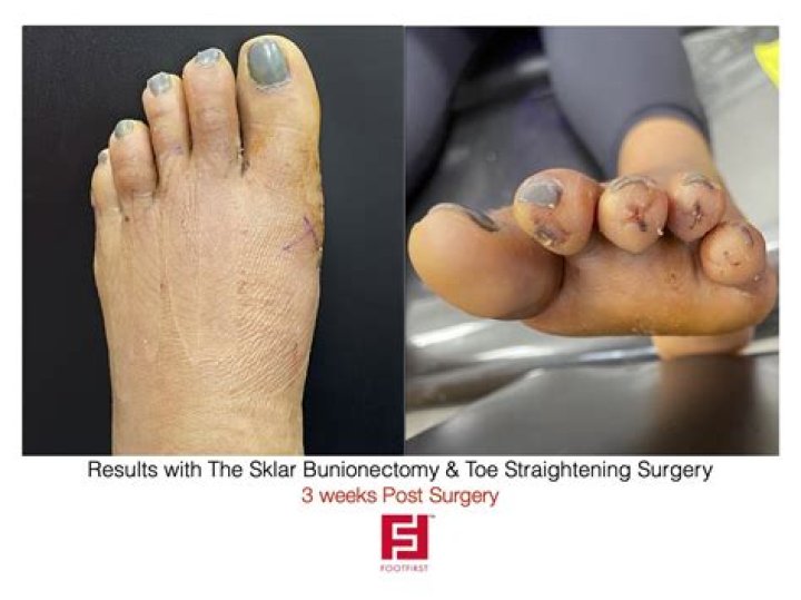 I had toe-shortening surgery — haters say I have 'Gremlin feet' now