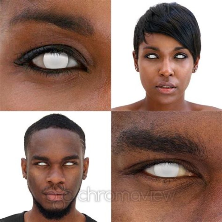 I went partially blind after showering in my contact lenses