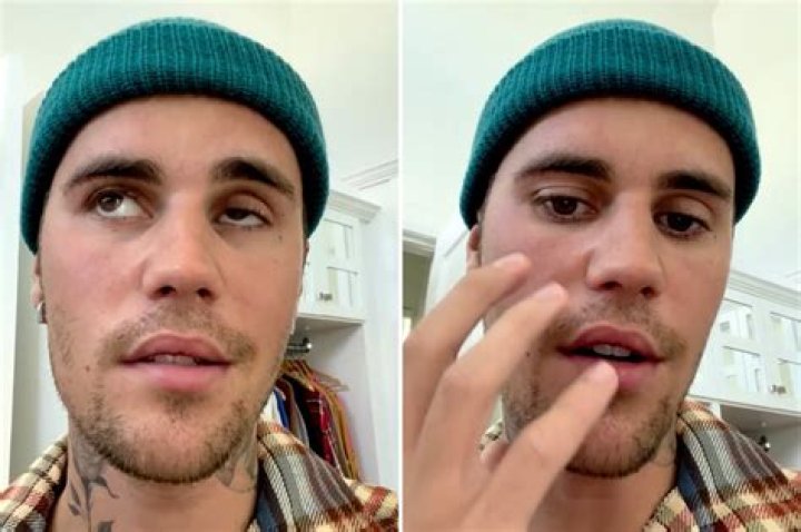 Justin Bieber’s face paralysis — what is Ramsay Hunt syndrome?