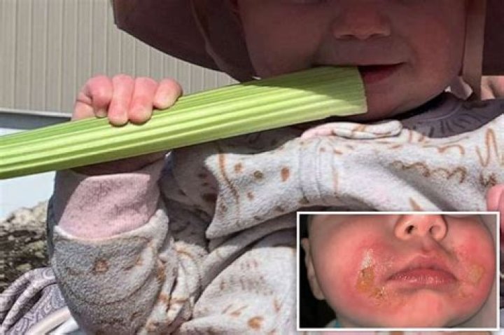 My baby got ‘margarita burn’ after eating celery: What parents should know