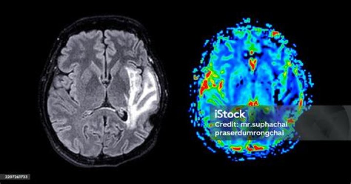NYC man's fatal brain disease linked to COVID-19: 'Highly likely'