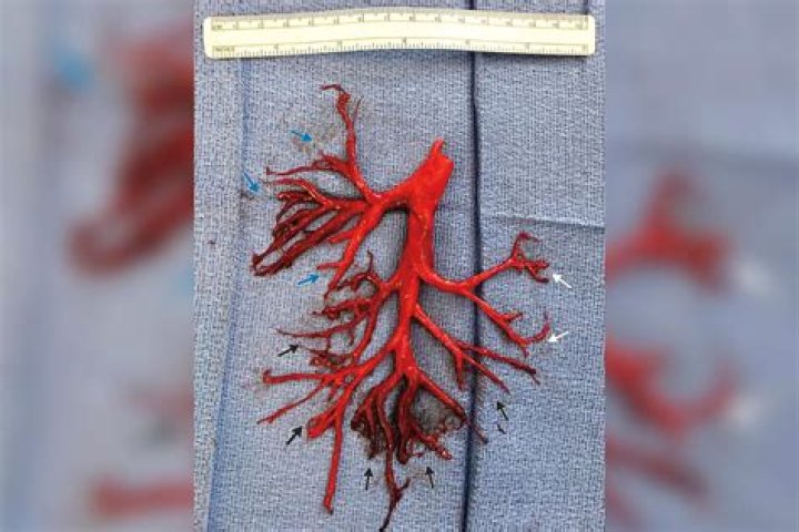 Patient dies after coughing up part of his lung during heart failure treatment
