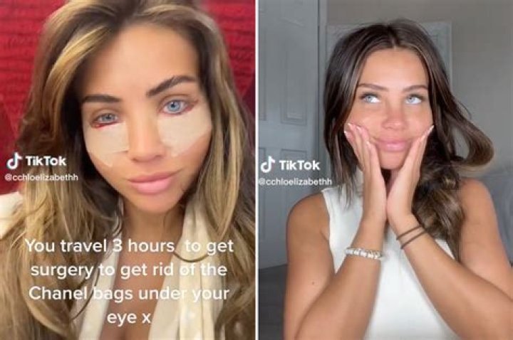 Plastic surgery to correct 'resting bitch face' is trendy