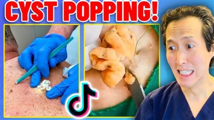 Pork ribs cyst-popping video disgusts viewers: ‘I’m going vegan’