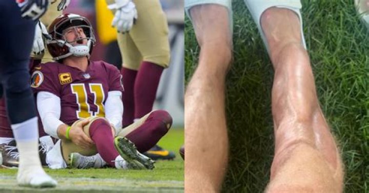 Redskins' Alex Smith out of leg brace after gruesome injury