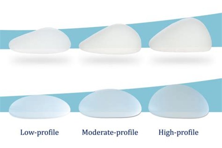 The era of the jumbo breast implant is over