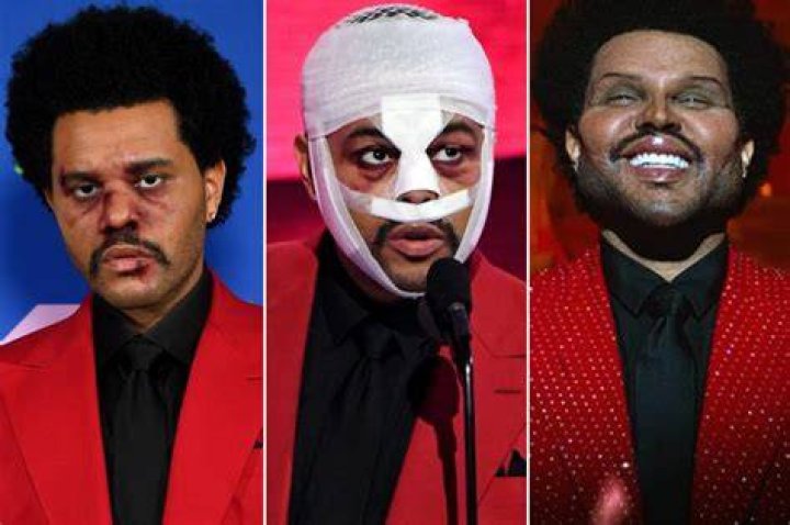 The Weeknd's Billboards face: Bloody 'surgery' shocker?
