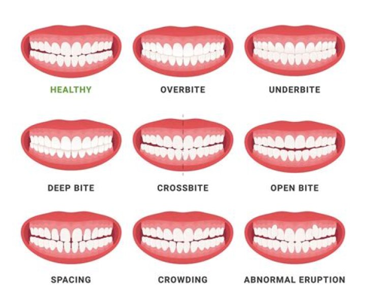 This is the reason you should never crunch ice with your teeth
