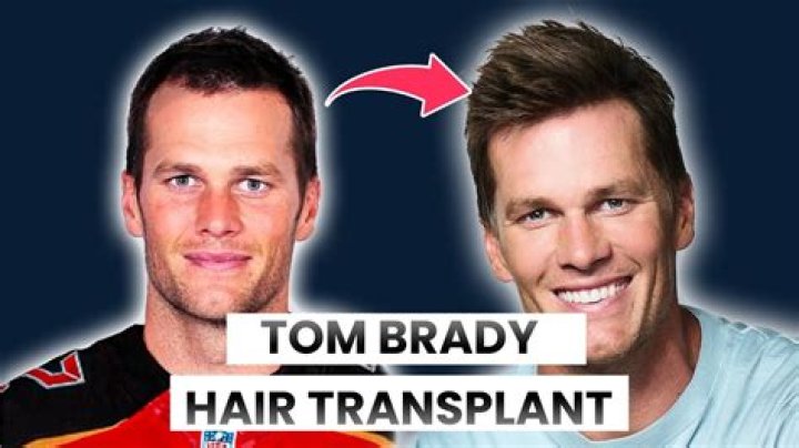 Tom Brady inspired my hair transplant!