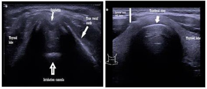 Ultrasound shows parasites wriggling about in man's stomach