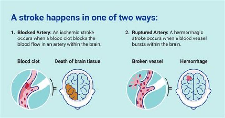 Wasp stings cause near-fatal stroke in medical first: case study