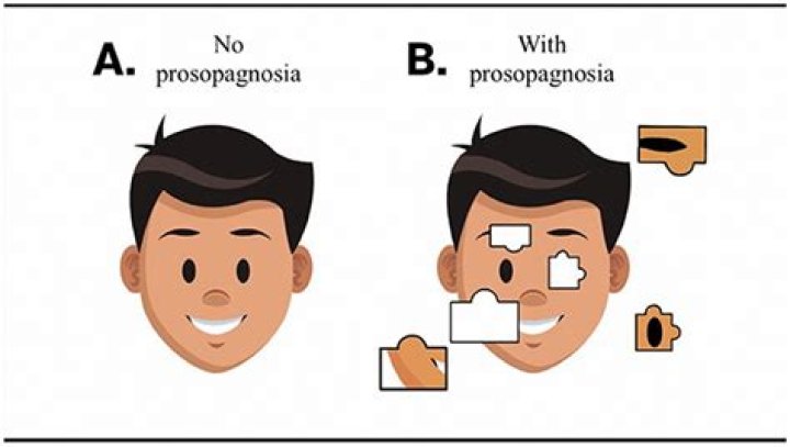 What is prosopagnosia? All about Brad Pitt's face blindness condition