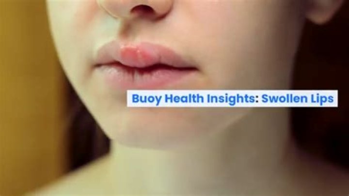 Woman's lips swell from drinking alcohol after injections