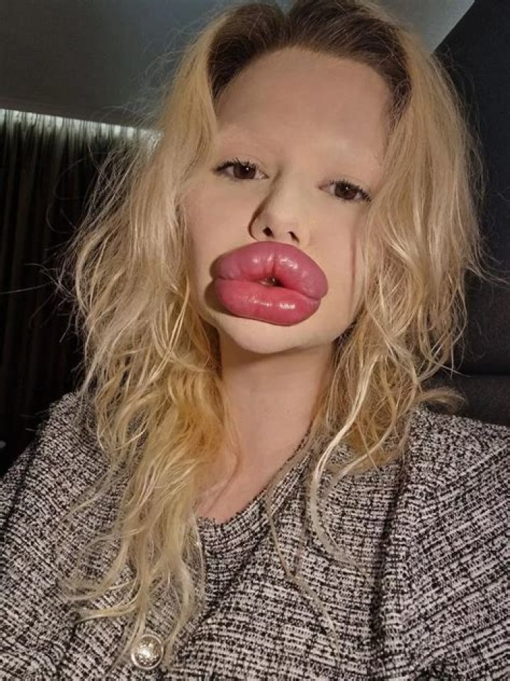 Woman with 'world's biggest lips’ is getting more injections