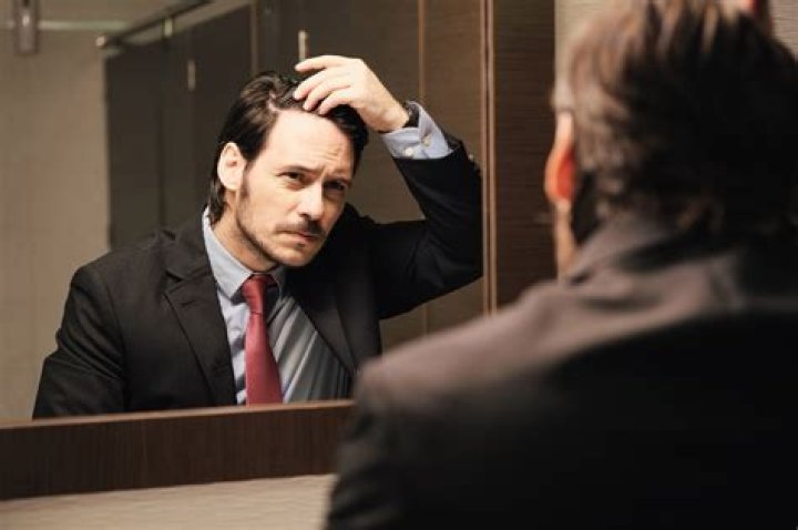 Working too much can make you go bald: study